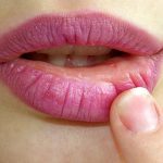 chapped lips